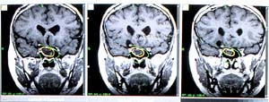 x-ray of three brains