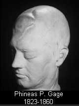 Phineas Gage, life mask, made for Henry Jacob Bigelow in 1849 or 1850.